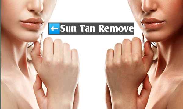 Sun Tan Remove Karne Ke Liye Gharelu Upaye